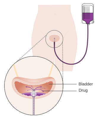 Lavaggio vescicale
