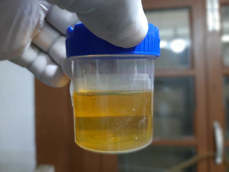 Raccolta sterile di campione di urina
